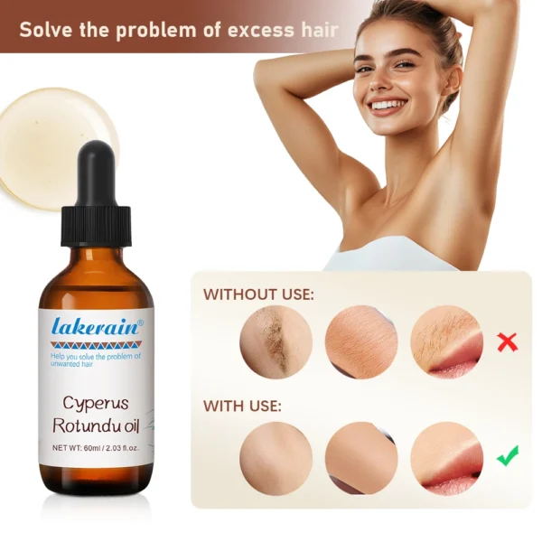 Semi-permanent Cyperus Rotundus Oil Hair Remover - Image 3